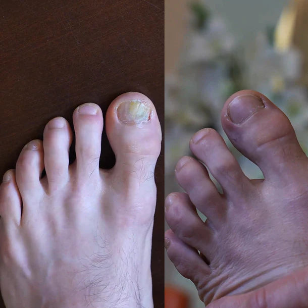 Pentachom SE - Antifungal Light Device