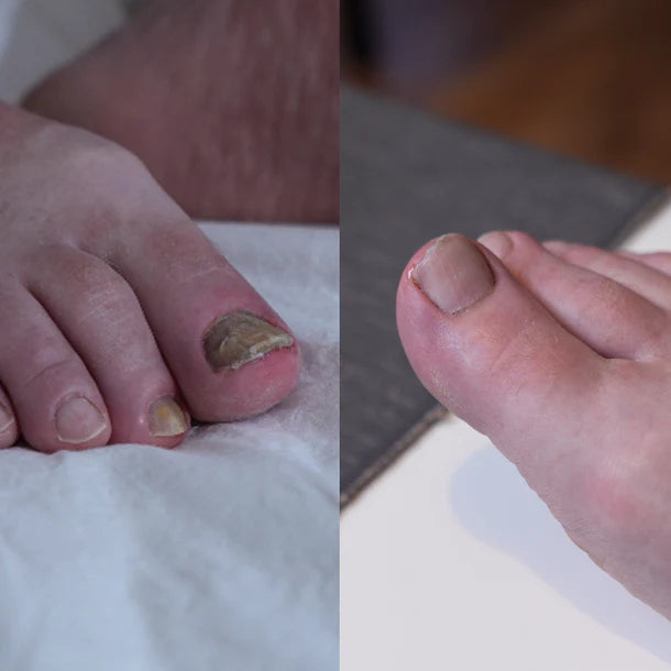 Pentachom SE - Antifungal Light Device